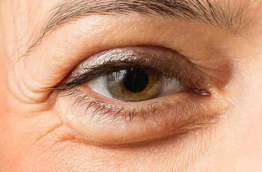 Eye Bag Removal Your Guide to Brighter Eyes.jpg