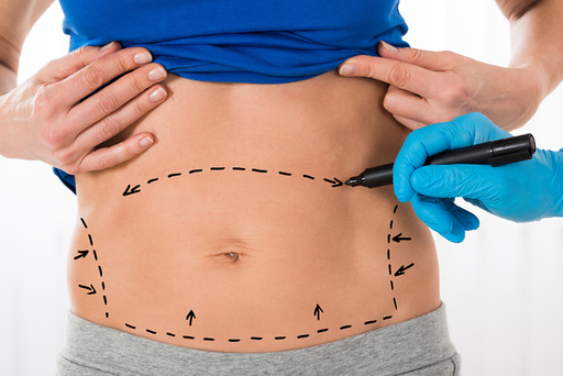 Tummy Tuck A Comprehensive Guide.jpg