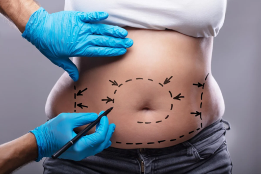 Everything You Need to Know About Tummy Tucks.png