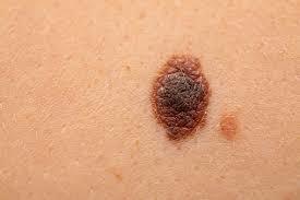 Skin Lesion Removal What You Need to Know.jpg