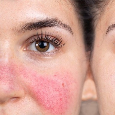 Rosacea Treatment in Dubai.jpg