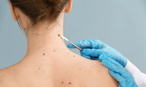 Skin Tag Removal.png