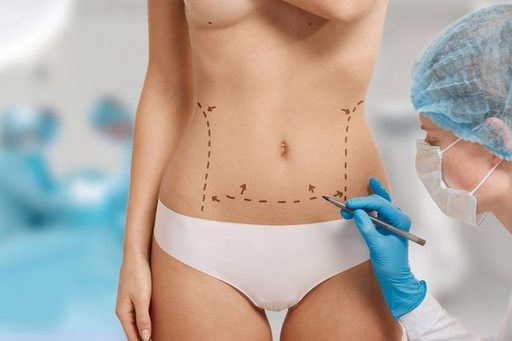 The Growing Demand for BodyTite Liposuction.jpg