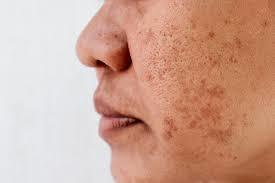 How to Manage Melasma Effectively.jpg