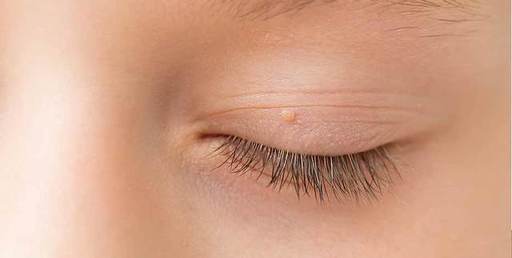 Eyelid Xanthelasma Removal for a Brighter Eye Area