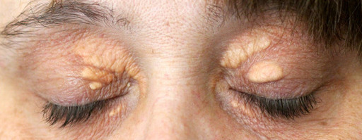 Top Methods for Eyelid Xanthelasma Removal.jpg